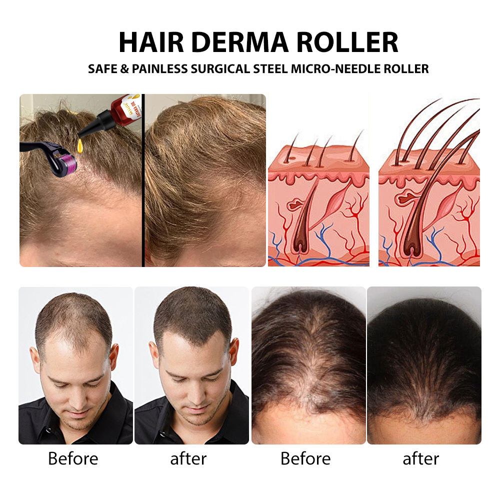 Hair Growth Derma Roller